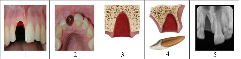 Gambar 12. Extrusive luxation (1) Tampak depan (2) Tampak oklusal (3) Tampak depan animasi            (4) Tampak lateral animasi (5) Gambar radiografi  