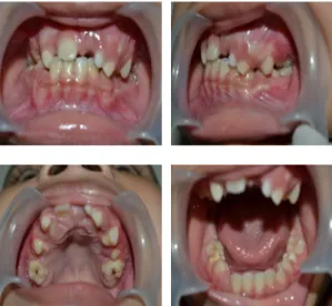 Gambar 2. Foto Intraoral