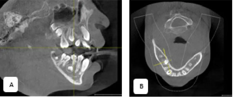 Gambar 11. Benih gigi supernumerari pada potongan sagital (A) dan potongan aksial (B)