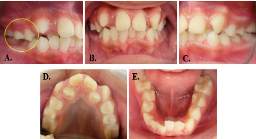 Gambar 2. Foto Klinis Intaoral Sebelum Perawatan. (A). Foto Arah Lateral Kanan, dengan Gambaran Scissor  Bite; (B)