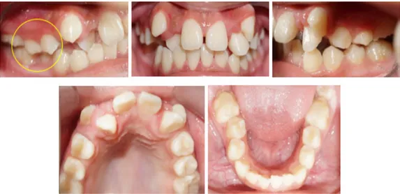 Gambar 7. Foto Klinis Intaoral Kontrol Empat Bulan Setelah Pemakaian Ortodonti Cekat. (A)