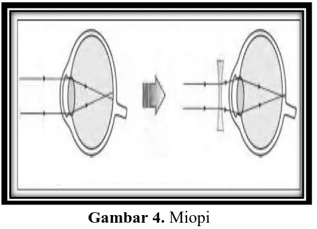 Gambar 4. Miopi Sumber: Giancolli, 2001