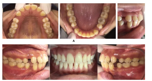 Gambar 2. A. Gambaran intra oral sebelum perawatan pada saat oklusi; B. Gambaran intra olral sebelum perawatan dalam  B arah oklusal dan overjet