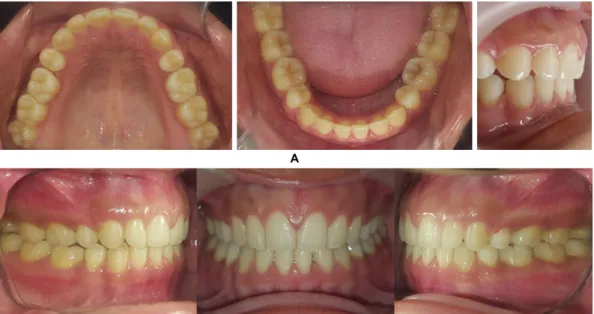 Gambar 6. A. Gambaran intra oral setelah perawatan pada saat oklusi; B. Gambaran intra oral setelah perawatan dalam  B arah oklusal dan overjet