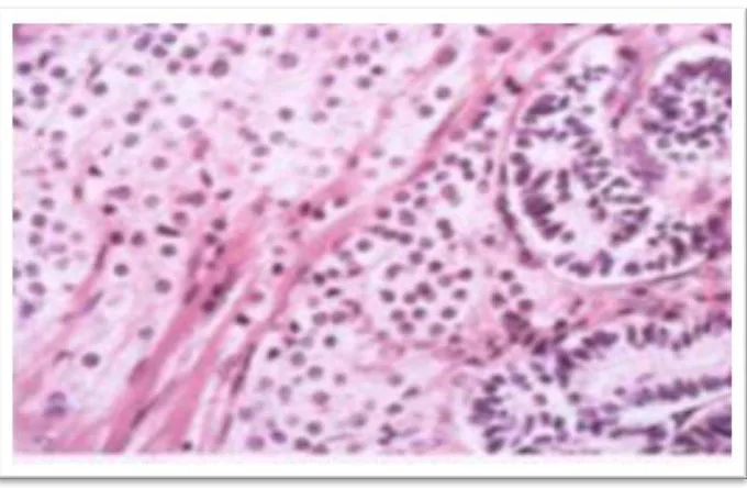 Gambar  2.23.  Sertoli-leydig cell tumor intermediated diffrentiated terdapat  bagian padat  Cords dari sel-sel sertoli mengelilingi kelompokan sel  leydig yang berada ditengah