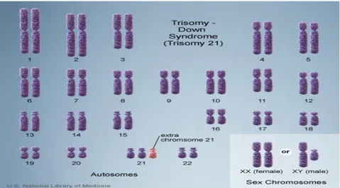 Gambar 1: Karyotype individu dengan trisomi 21. 26 