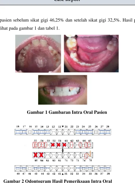 Gambar 1 Gambaran Intra Oral Pasien 