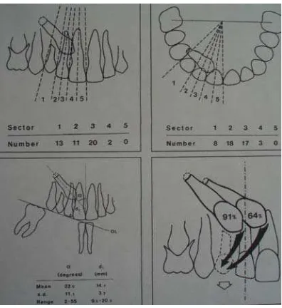 Gambar 1.Penelitian Ericson dan Kurol (1988), berdasarkan angulasi, sektor dan                 distibusi gigi kaninus impaksi