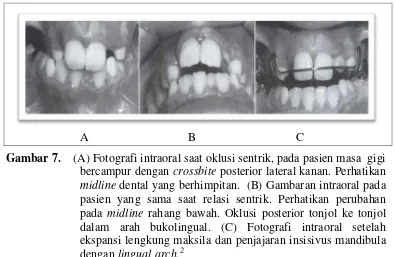 Gambar 7.    (A) Fotografi intraoral saat oklusi sentrik, pada pasien masa  gigi 