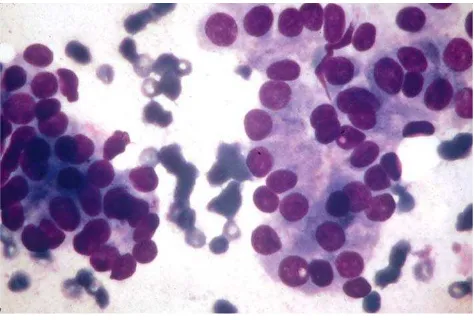 Gambar 1. Karsinoma Folikular. diagnostic cytology and its histopathologic bases. The Thyroid, Parathyroid, and Neck Masses Other cytoplasmic inclusion Agregat sel-sel folikular dengan nukleus besar dan intranuclear kecil