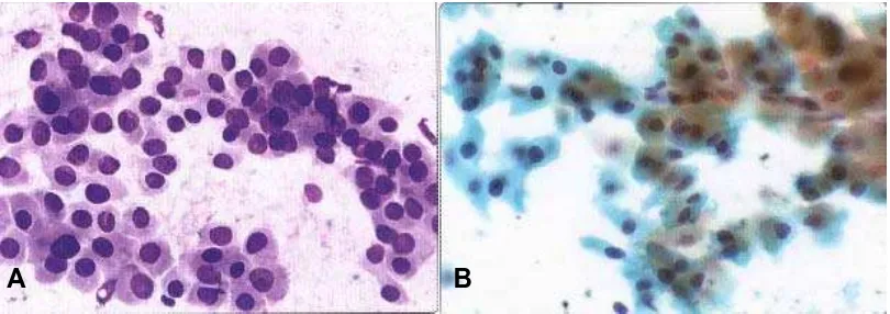 Gambar 4. Oxyphil (Hurtle cell) carcinoma. B. Sel-sel  A. Kelompokan trabekular sel-sel oxyphil (MGG, HP)