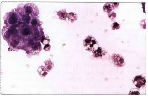 Gambar 6. Cystic papillary carcinomakelompokan degenerasi sel-sel epitelial atipik (MGG, HP)