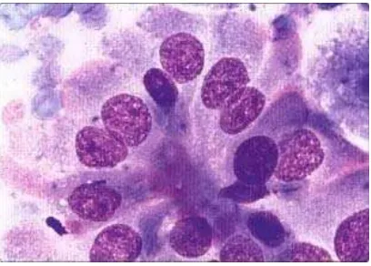 Gambar 8. Tall-cell papillary carcinoma. Kelompokan sel-sel epitelial tall columnar berdekatan dengan material membran basal; sitoplasma banyak, nukleus lebih atipikal daripada karsinoma papiler klasik(MGG, HP)