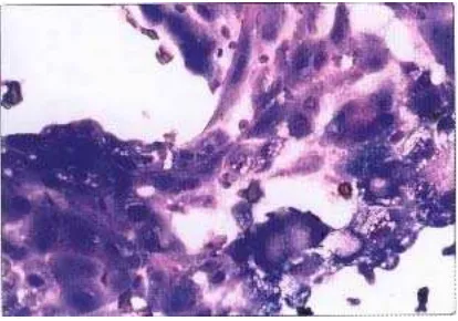 Gambar 10. Diffuse sclerosing variant of papillary carcinoma. sel-sel metaplasia, fibroblast dan beberapa  Banyaknya fragmen jaringan terutama psammoma bodies