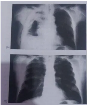 Gambar  3.  Ultrasonografi  Menunjukkan  Efusi  Pleura  Parapneumonik Bersepta Kompleks 