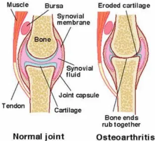 Gambar 2.1 Osteoarthritis 