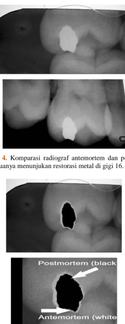 Gambar  4.  Komparasi  radiograf  antemortem  dan  postmortem  yang keduanya menunjukan restorasi metal di gigi 16