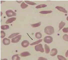 Gambar 4.6. Sickle cell ke-1