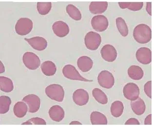 Gambar 4.12. Teardrops cell dan ovalosit citra ke-3 