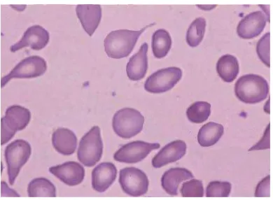 Gambar 4.15. Citra Teardrops cell dan ovalosit asli ke-4 