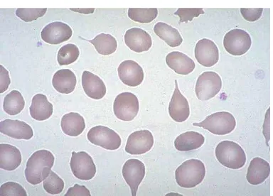 Gambar 4.17. Citra Teardrops cell,ovalosit dan schistocytes Citra ke-5 