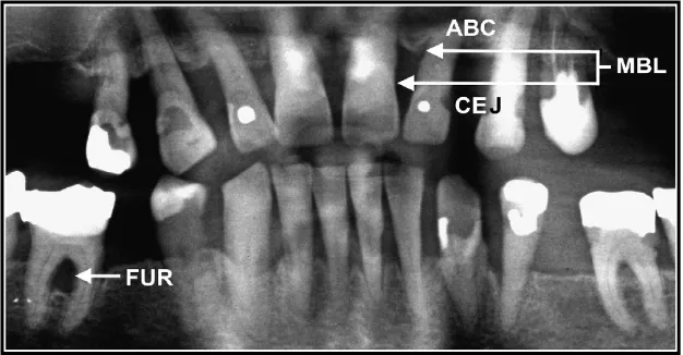 Gambar.4  Orthopantomogram dengan kehilangan tepi tulang yang signifikan pada pasien dengan PPOK berat