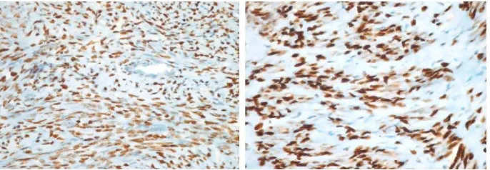 Gambar 6. Ekspresi reseptor estrogen (kiri) dan reseptor progesteron (kanan) pada         mioma uteri.(dikutip dari 36) 