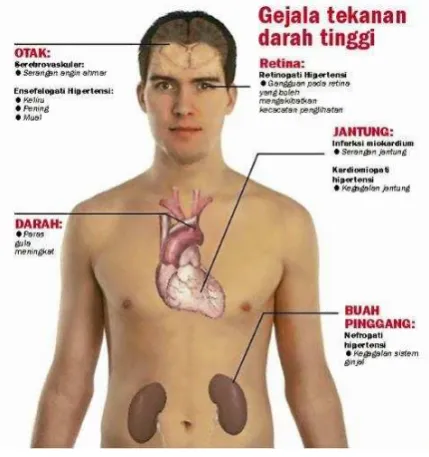 Gambar 1. Gejala Hipertensi 