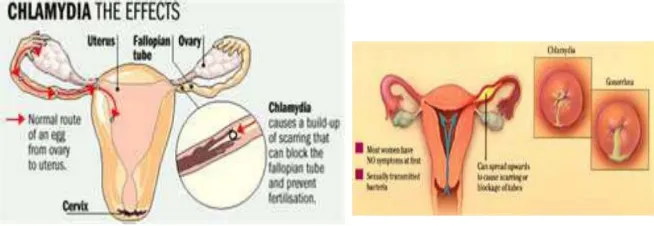 Gambar 5 Infeksi Chlamydia trachomatis pada jaringan serviks dan