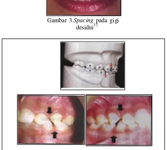 Gambar 3.Spacing pada gigi 