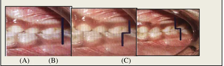 Gambar 4. (A) Hubungan molar flush terminal plane, (B) Hubungan molarmesial step,dan (C)Hubungan molar distal step31 