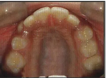Gambar 7. Erupsi gigi premolar31