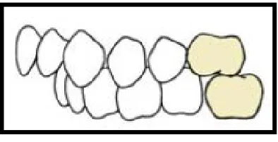 Gambar 11. Maloklusi Klas I Angle20 