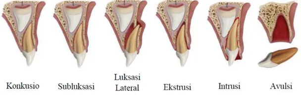 Gambar 5. Kerusakan pada jaringan periodontal2 