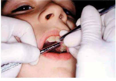 Gambar 8. Pemeriksaan mobiliti gigi  
