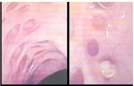 Gambar 2.4 Barium Enema
