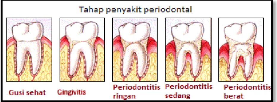 Gambar 3. Tahap penyakit periodontal 24