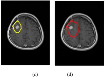 Figure 4.2: Contouring results of the axial image on slice number 16 (a) Initial image (b) GTV contour (c) CTV contour, and (d) PTV contour