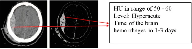 Figure 15. The result of the determination of timing of the brain hemorrhages based on HU.