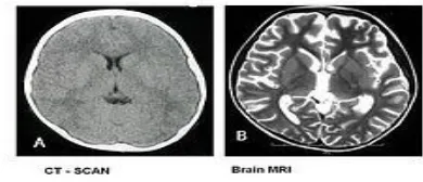 Gambar 2. A). CT-Scan dan B) Brain MRI 