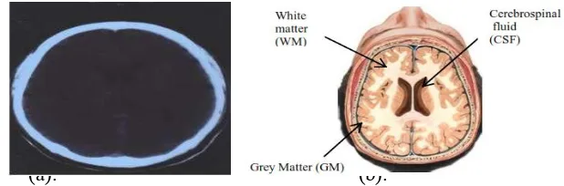 Gambar 3. (a). Penampang otak sehat dan (b). Penampang otak normal dari MRI  Sumber : Limin Luo et al (2012), T.-s