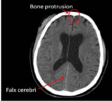Figure 8. The falx cerebri and the bone protrusion. 