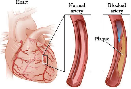 Gambar 1.1 Plak Aterosklerosis Arteri Jantung 