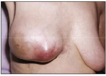 Gambar 2.5. Gambaran tumor phyllodes pada perempuan usia pertengahan.3 Terlihat terdapat peregangan kulit diatas tumor dengan 
