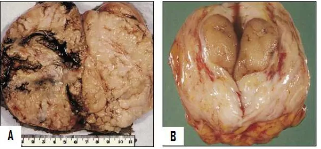 Gambar 2.8. Gambaran makroskopis tumor 5