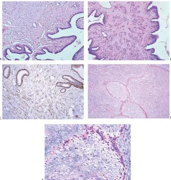 Gambar 2.10. Gambaran mikroskopis tumor phyllodes jinak dengan stroma miofibroblastik.pseudoangiomatousStroma pada tumor jinak dengan pola 5 A