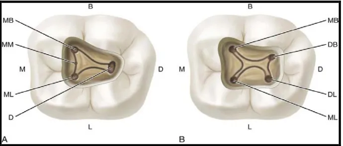 Gambar 10. Variasi jumlah orifisi  molar satu  mandibula  permanen                     (B=bukal,     L = Lingual, M = Mesial, D = Distal,  MB =                     Mesiobukal,  MM = Middle Mesial, ML=Mesiolingual).18  