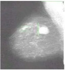 Gambar II.4. ( a ) Pasien Struma, ( b ) Hasil radiografi jaringan lunak struma 