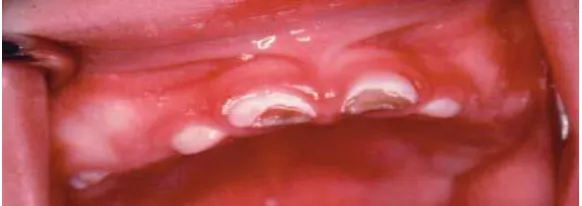 Gambar 3. Kavitas berwarna coklat dan kerusakan pada anterior       insisivus rahang atas 8 