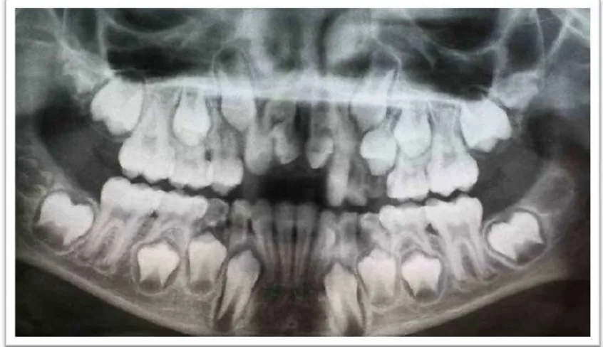 Gambar 6. Erupsi gigi periode gigi bercampur23
